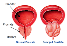 A normal and an enlarged prostate